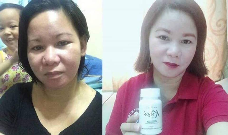 kirei glutathione testimonials Skin Whitening 60 Capsules Authentic Kirei Glutathione (30 capsules)